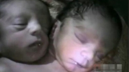 印度双头女婴 盘点最不可思议连体双胞胎