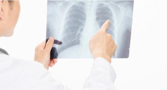 慢阻肺或引起肺癌 专家：慢阻肺患者应定期做CT检查