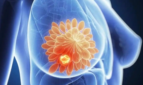 乳腺结节、乳腺增生会癌变吗？8 个高危因素要注意