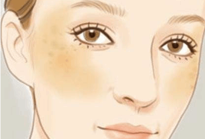 女性脸上斑点越来越多？从8个方面找找原因