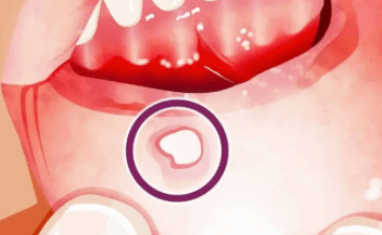 口腔溃疡确诊舌癌？哪几种口腔溃疡很危险