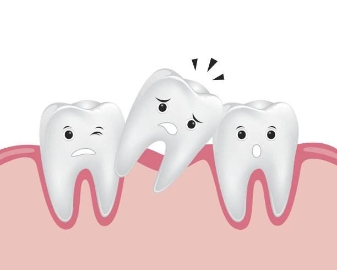 牙齿矫正如何选择牙套 牙齿矫正要注意什么