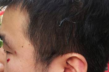 The picture, supplied by Mr Li, shows cuts around his eye caused by the attack and egg on the side of his head