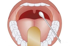 扁桃体老是发炎要切吗 五种情况可考虑手术