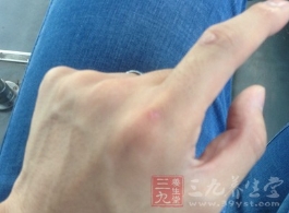 测手指看健康：手掌泛红可能肝脏出问题