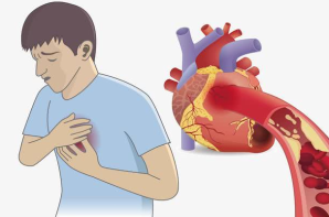 身体出现这四个信号 需要警惕急性心肌梗死