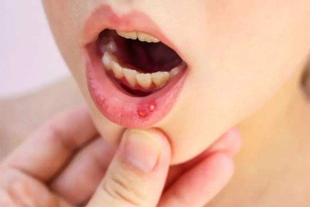 哪些口腔溃疡需看医生 每天刷牙需自查7个部位