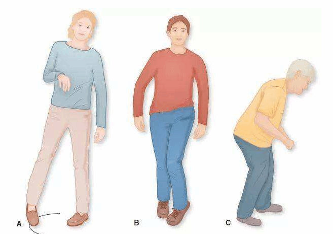 注意六种奇奇怪怪的走路姿势 暗藏健康危机