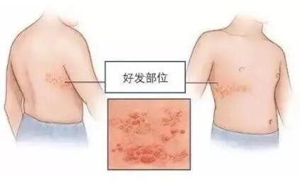 秋季当心带状疱疹“趁虚而入”？4件事预防带状疱疹