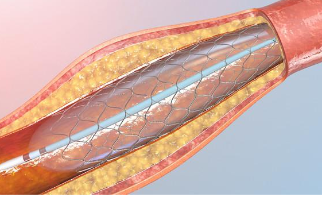 冠脉支架“跳水价”执行半个多月 质量打折没