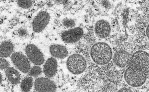 西班牙猴痘确诊病例超5000例 死亡病例2例