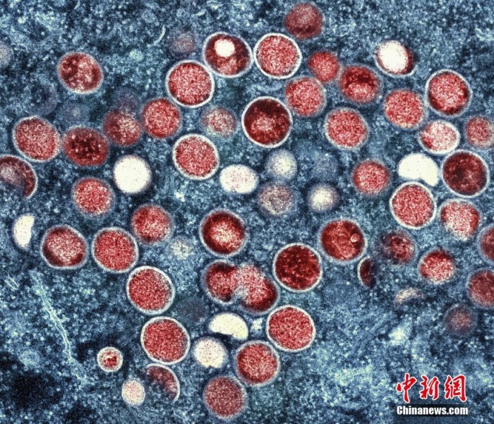 当地时间2022年7月26日,美国马里兰州,在实验室培养的感染细胞(棕色)中发现的猴痘颗粒(橙色)的彩色透射电子显微图。世界卫生组织最近宣布,不断扩大的猴痘疫情为全球紧急情况。这是世卫组织的最高警戒级别,但这一级别并不一定意味着疾病具有特别的传染性或致命性。图片来源:视觉中国 当地时间2022年7月26日,美国马里兰州,在实验室培养的感染细胞(棕色)中发现的猴痘颗粒(橙色)的彩色透射电子显微图。世界卫生组织最近宣布,不断扩大的猴痘疫情为全球紧急情况。这是世卫组织的最高警戒级别,但这一级别并不一定意味着疾病具有特别的传染性或致命性。图片来源:视觉中国