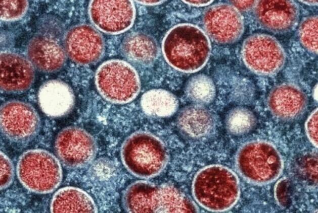 美国猴痘疫情持续蔓延 病例已近1.7万例 