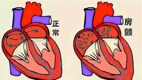 心房扑动与颤动的区别 心房颤动需要治疗吗