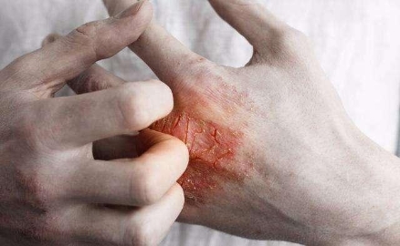 疥疮和湿疹有什么区别？手部湿疹怎么治疗