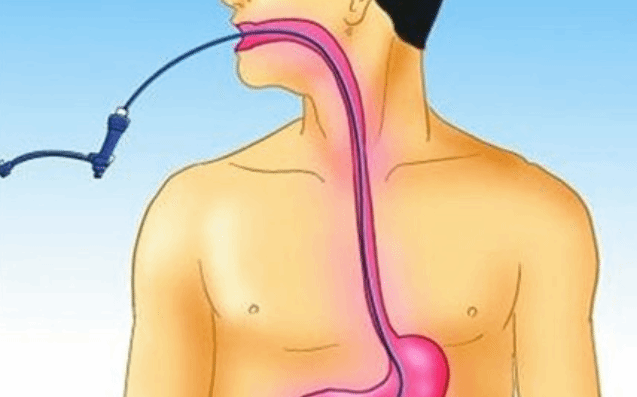 消化道出血做胃镜能检查吗？胃镜前后要注意这4点