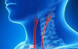 哪些原因会导致颈动脉狭窄？要定期筛查颈动脉