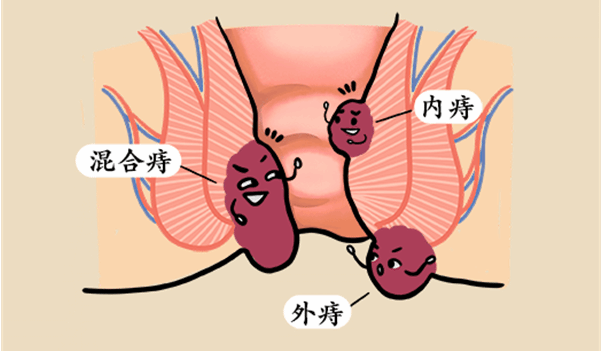 “十人九痔”别大意 五大妙招帮你一次解决