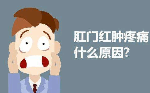 肛门疼痛不一定是痔疮 或是这6种疾病在作怪