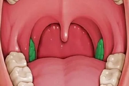 小儿有扁桃体肿大怎么办？教你5招来应对