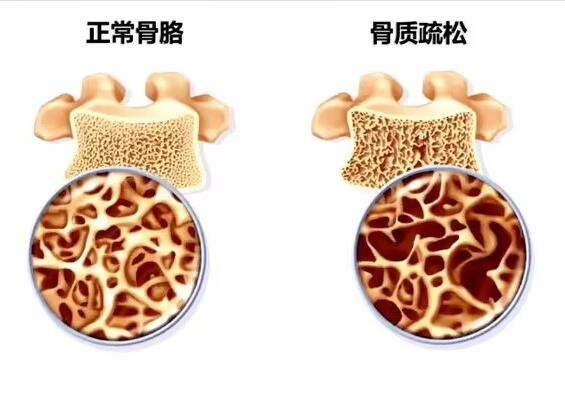 不想让骨头变脆 这4件事一定要少做