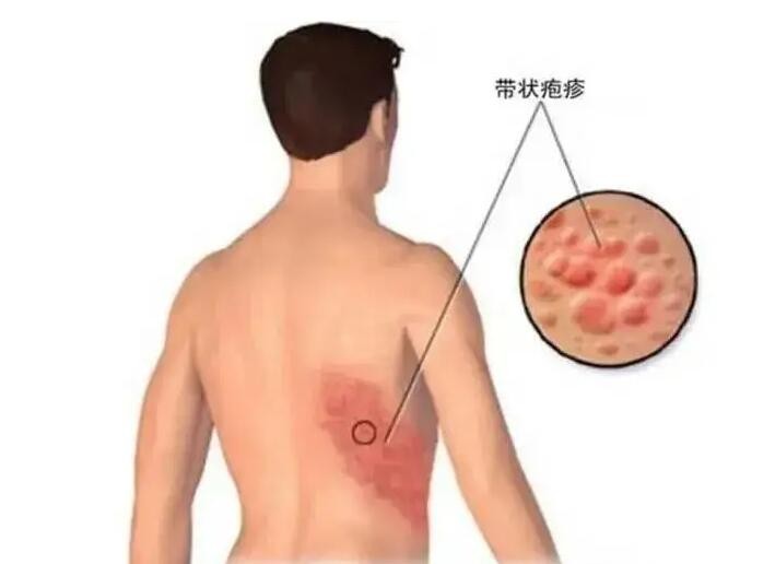 带状疱疹很可怕？除了治疗 还要做好这5大护理