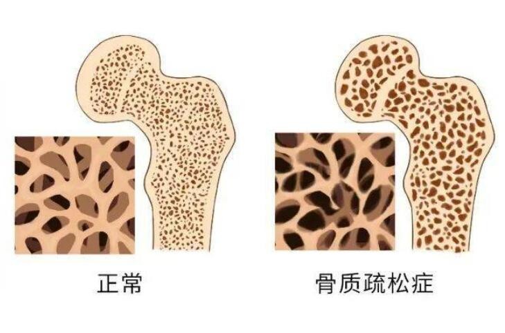 得了骨质疏松怎么办？治疗护理两手抓