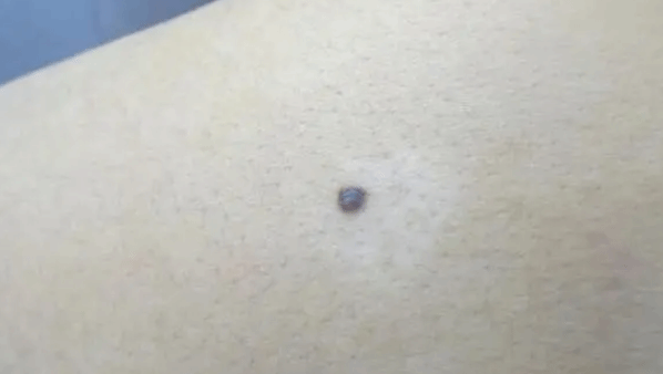 皮肤黑痣警惕这五种变化 做到早发现早治疗