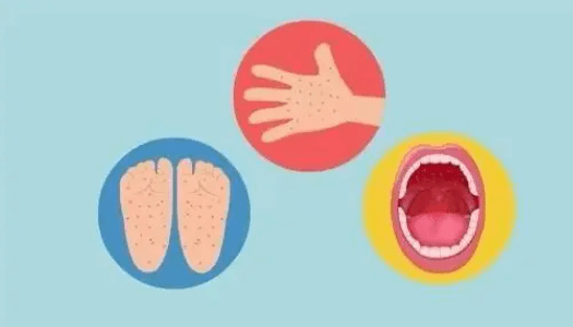 如何预防手足口病最有效？上海疾控解答