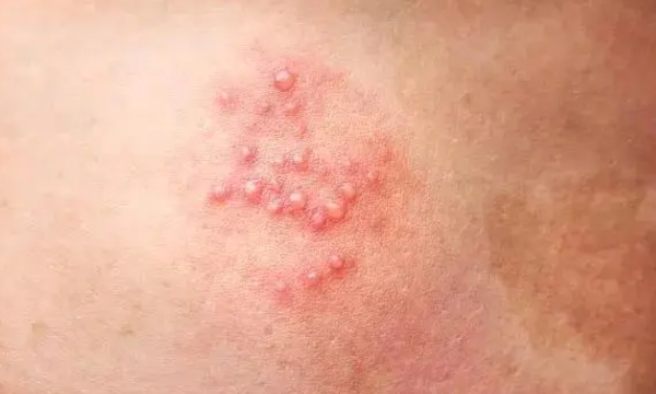 带状疱疹是常见皮肤病 秋季要谨防带状疱疹