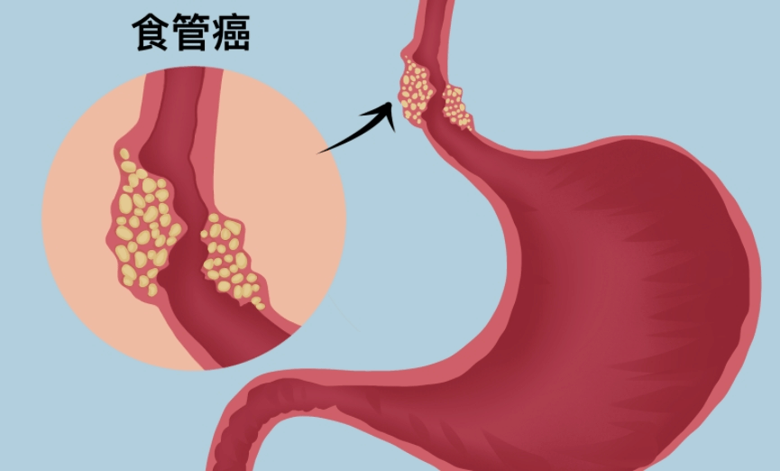 食管癌发现的早在内镜下就可以切除？需要满足以下条件