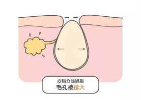 脸上毛孔粗大怎么办？教你五招来收缩毛孔