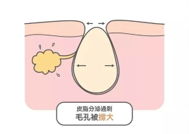 脸上毛孔粗大怎么办？教你五招来收缩毛孔