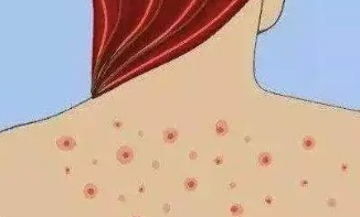 后背经常长痘痘是怎么回事？排查这4个原因