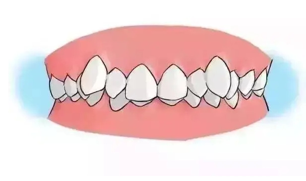 “龅牙”矫正不可盲目 四类嘴突类型要对症下药