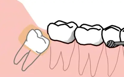 什么样的智齿需要拔除？这三种请需要拨出