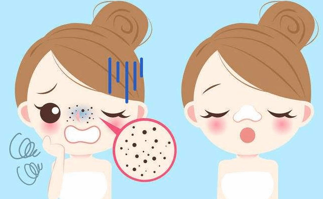 如何去除黑头？这4种方法很管用值得一试