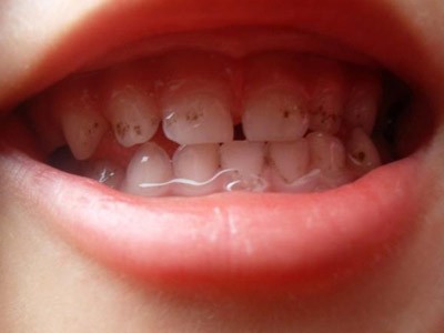 孩子牙齿发黑是怎么回事？这4个诱因要注意