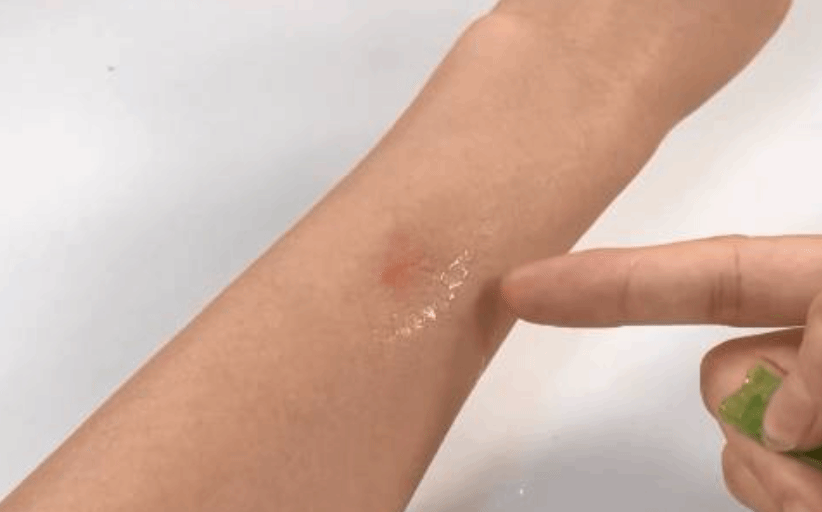 被蚊子咬了怎么止痒消肿 怎么预防蚊子咬