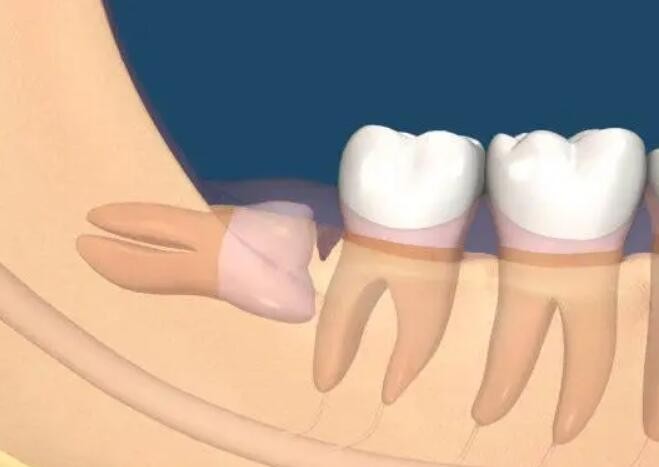 智齿一定要拔吗？出现这种情况 一定要拔掉