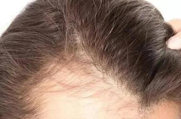 你是否也有“头皮健康焦虑”？盘点6个困扰人们的头皮问题
