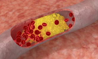 胆固醇是指什么？高胆固醇有哪些饮食误区