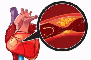 吃“活血”补品能防心梗？没想到真的梗了