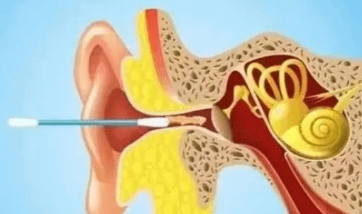 耳屎会越挖越多吗？如何正确地“掏耳朵”