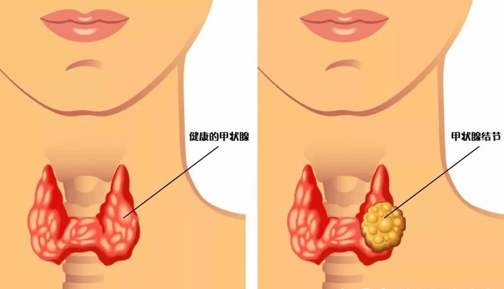 女人为什么容易得甲状腺结节  这3大因素在作妖