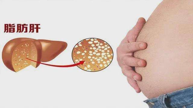 这5类人群很容易得脂肪肝 要积极做好预防