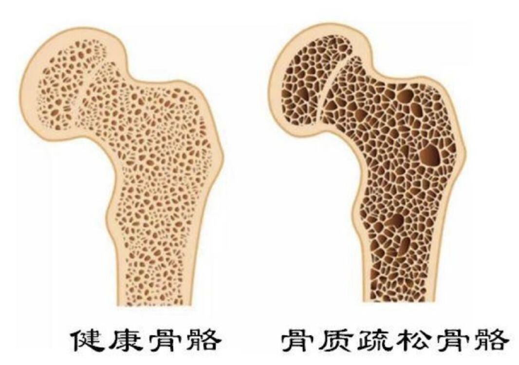一分钟自测骨质疏松风险？预防骨质疏松要做好这3件事